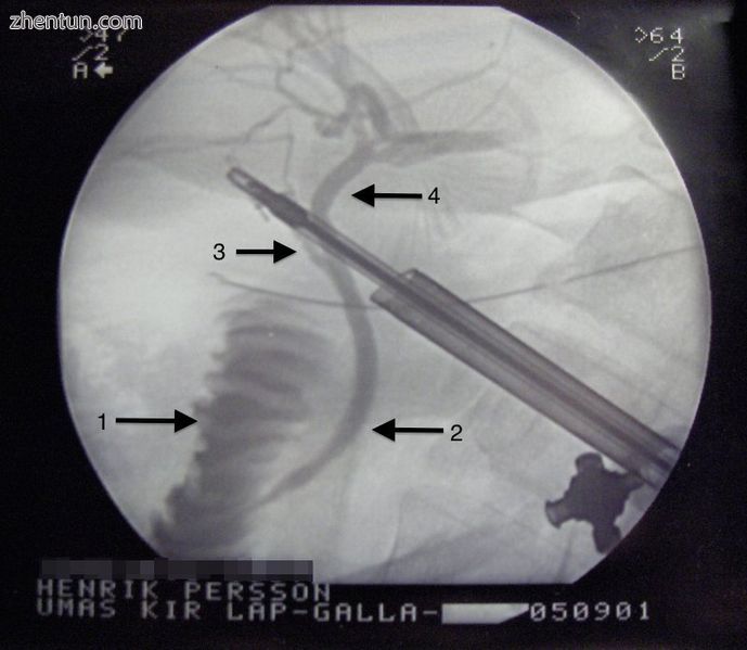 This is a cholangiogram, an x-ray of the bile ducts using contrast medium to mak.jpg