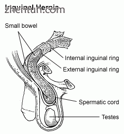 Diagram of an indirect inguinal hernia (view from the side)..gif