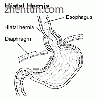 Diagram of a hiatus hernia (coronal section, viewed from the front)..gif