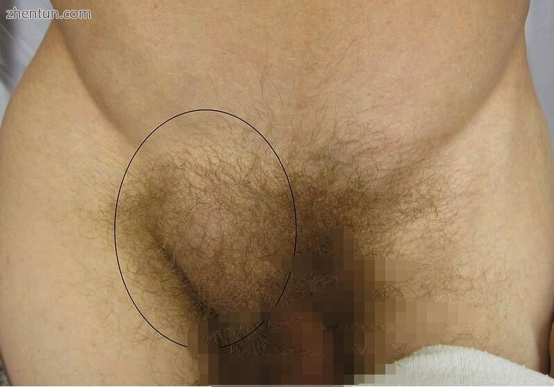 Frontal view of an inguinal hernia (right)..JPG