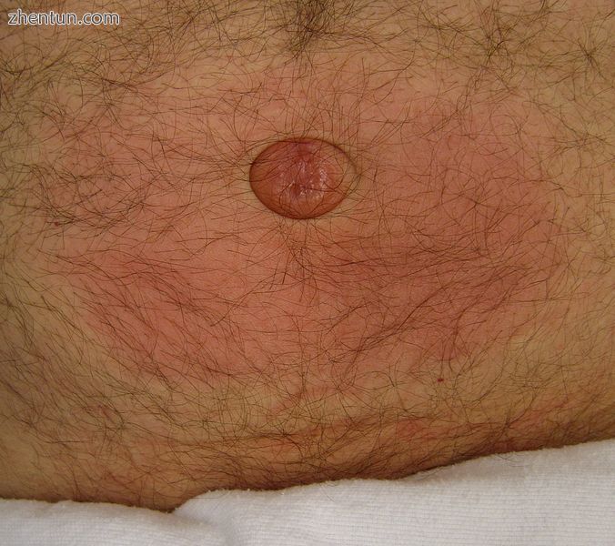 Incarcerated umbilical hernia with surrounding inflammation.JPG