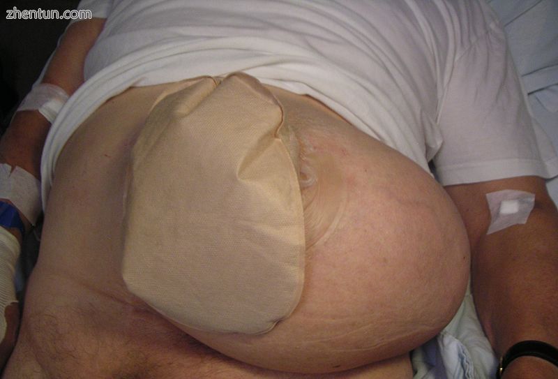 Patient with a colostomy complicated by a large parastomal hernia..JPG