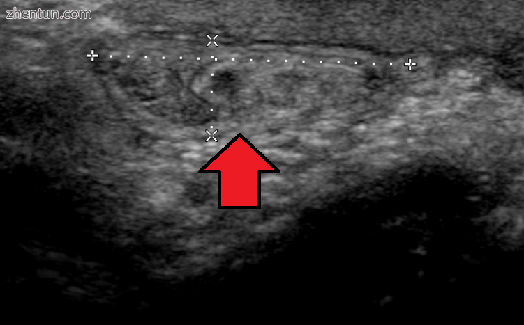 Ultrasound showing an inguinal hernia.png