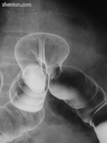 X-ray of colonic herniation.jpg