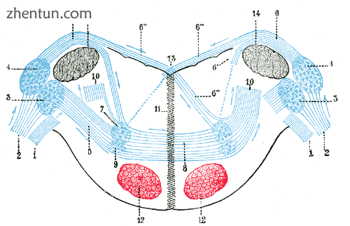 In children, the most common cause is a stroke of the ventral pons.[9].png