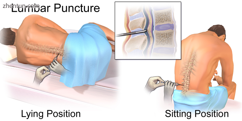 Illustration depicting common positions for lumbar puncture procedure..png