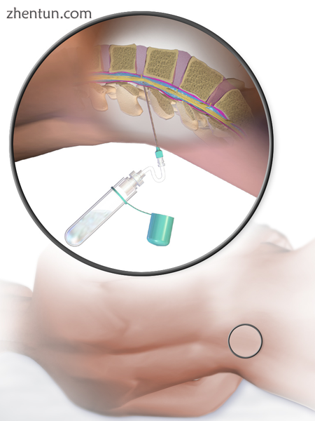 Illustration depicting lumbar puncture (spinal tap).png