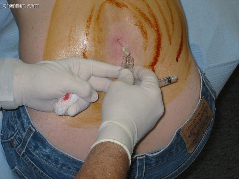 Lumbar puncture in a sitting position. The reddish-brown swirls on the patient&#.jpg