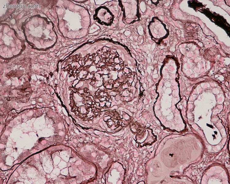 Photomicrograph of renal biopsy showing crescent formation and tuft narrowing. P.jpeg
