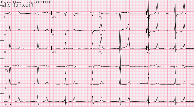 A 12-lead ECG of a person with CKD and a severe electrolyte imbalance.png