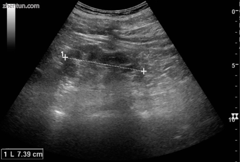 Chronic pyelonephritis with reduced kidney size and focal cortical thinning. Mea.jpg