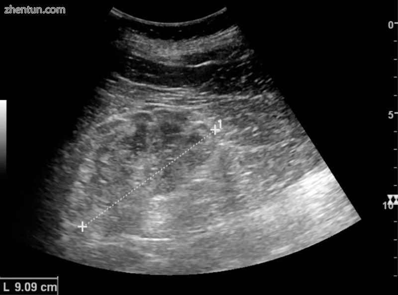 Chronic renal disease caused by glomerulonephritis with increased echogenicity a.jpg