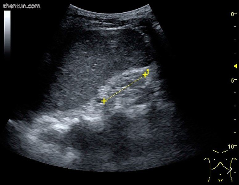 End-stage chronic kidney disease with increased echogenicity,.jpg