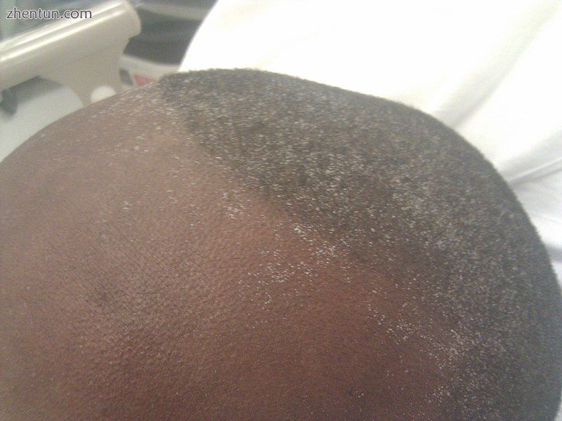 Uremic frost on the head in someone with chronic kidney disease.jpg