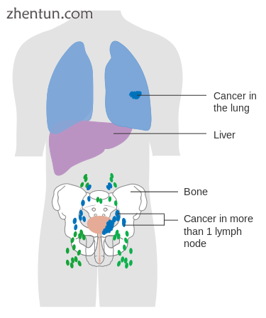 Advanced bladder cancer.png