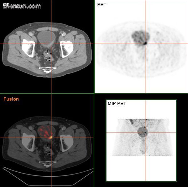Bladder tumor in FDG PET due to the high physiological FDG-concentration in the .jpg