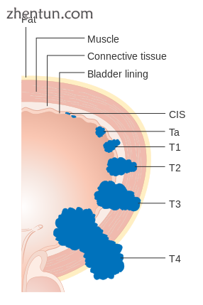 Diagram showing the T stages of bladder cancer.png