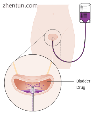 Drug treatment (chemotherapy) into the bladder.png