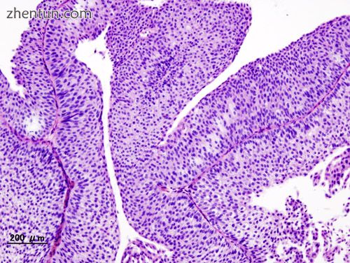 Histopathology of urothelial carcinoma of the urinary bladder. Transurethral bio.jpg