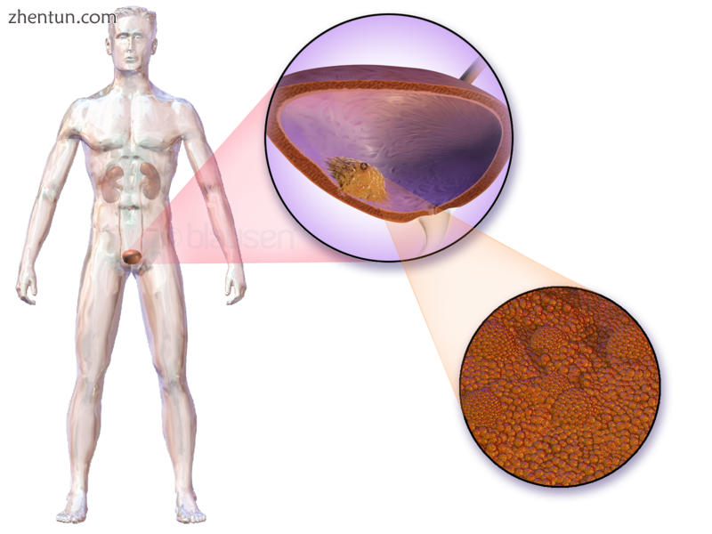 Location of bladder cancer.png