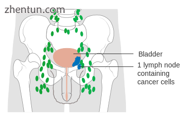 Stage N1 bladder cancer.png