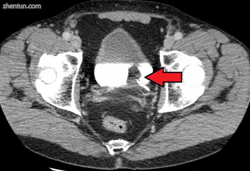 Transitional cell carcinoma of the bladder. The white in the bladder is contrast..png