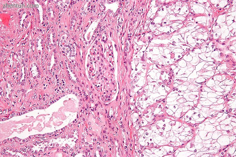 Micrograph of the most common type of renal cell carcinoma (clear cell)—on righ.jpg