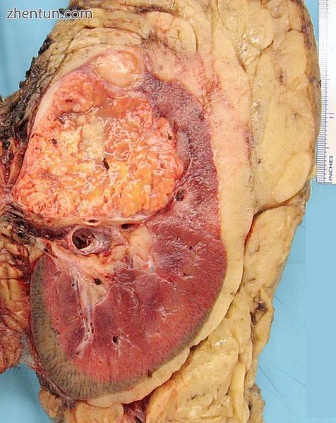 Renal cell carcinoma2.jpg