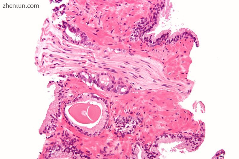 Micrograph demonstrating perineural invasion of prostate cancer. H&amp;E stain..JPG