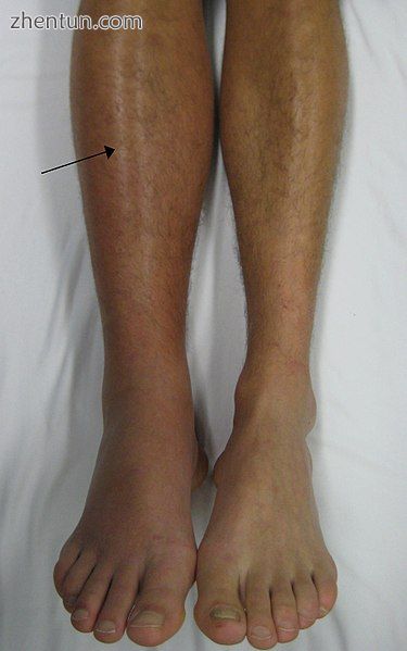 A deep vein thrombosis as seen in the right leg is a risk factor for PE.jpg