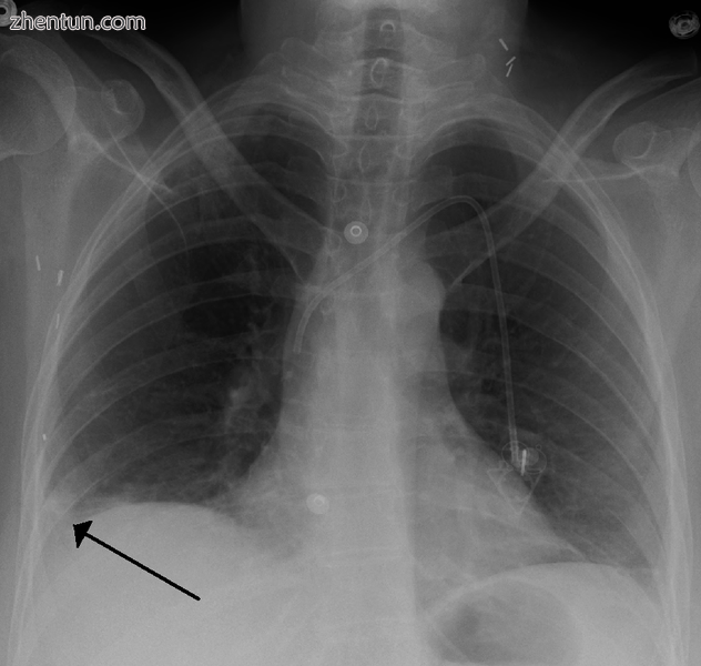 A Hampton hump in a person with a right lower lobe pulmonary embolism.PNG
