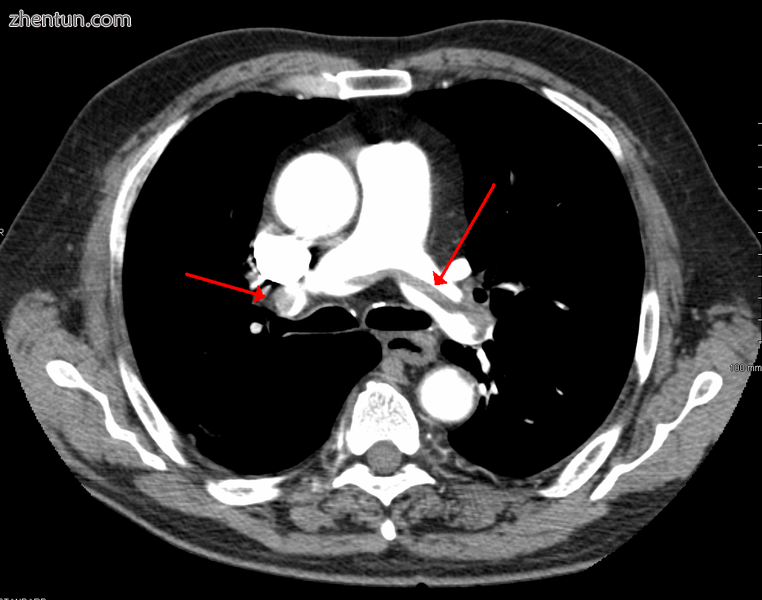 Chest spiral CT scan with radiocontrast agent showing multiple filling defects b.png