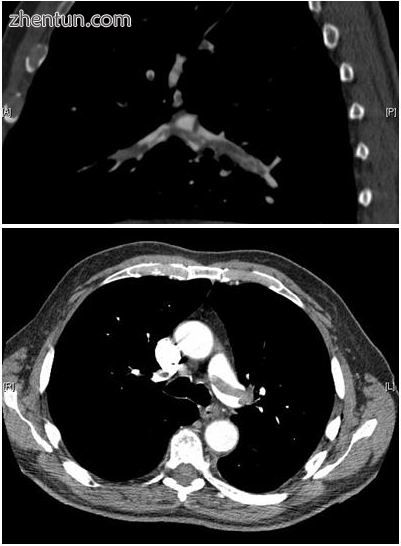 CT pulmonary angiography showing a.JPEG