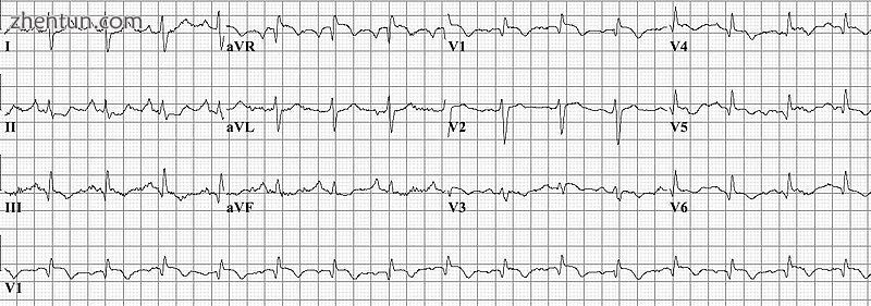 Electrocardiogram of a person with pulmonary embolism.jpg