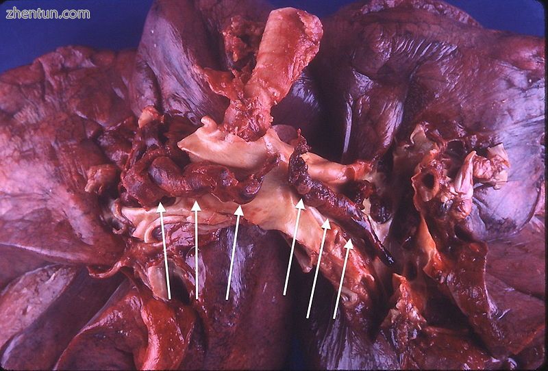 Large saddle embolus seen in the pulmonary artery (white arrows)..jpg