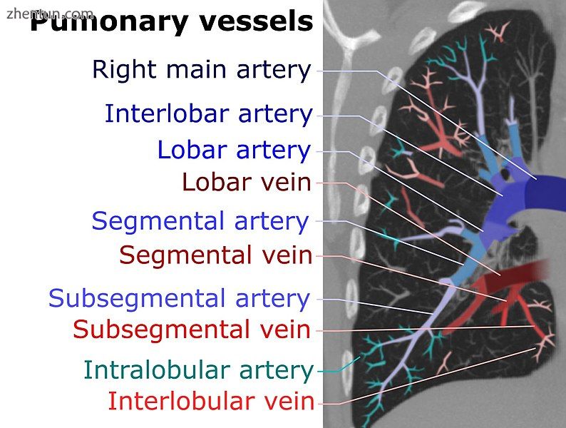 On CT scan, pulmonary emboli can be classified according to level along the arte.jpg