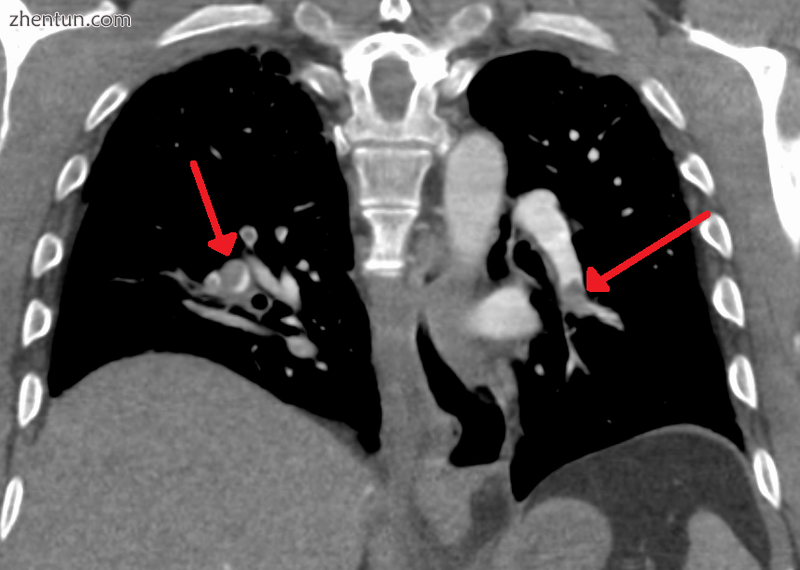 Segmental and subsegmental pulmonary emboli on both sides.png