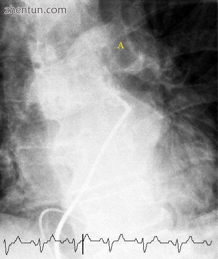 Selective pulmonary angiogram revealing clot (labeled A) causing a central obstr.jpeg