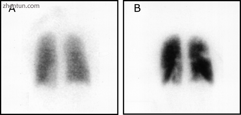 Ventilation-perfusion scintigraphy.png