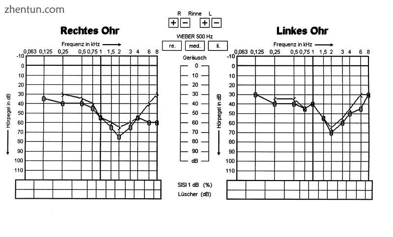 Hearing loss effect of Alport syndrome in 13-year-old boy.jpg