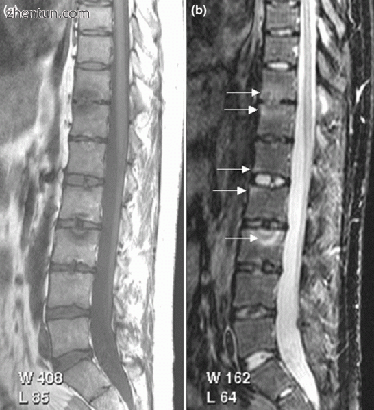 (a) T1-weighted and (b) short tau inversion recovery (STIR) magnetic resonance i.gif