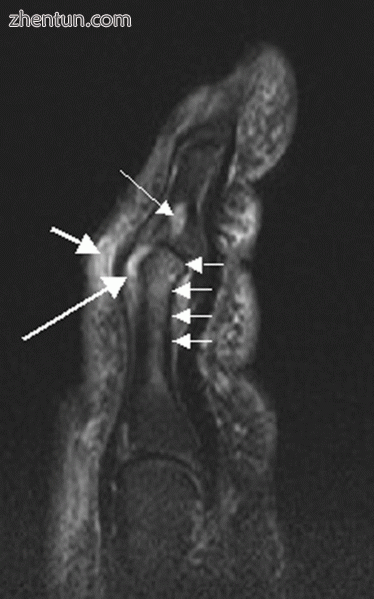 Magnetic resonance image of the index finger in psoriatic arthritis (mutilans fo.gif
