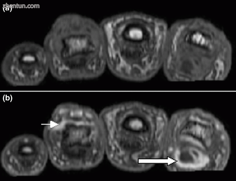 Magnetic resonance images of the fingers in psoriatic arthritis. Shown are T1 we.gif