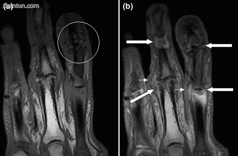 Magnetic resonance images of the fingers in psoriatic arthritis. Shown are T1-we.gif