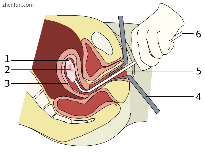 A vacuum aspiration abortion at eight weeks gestational age (six weeks after fer.png