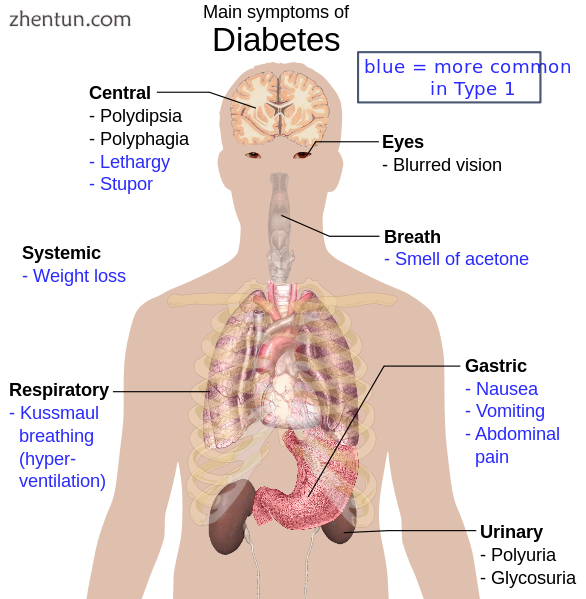 Overview of the most significant symptoms of diabetes.png