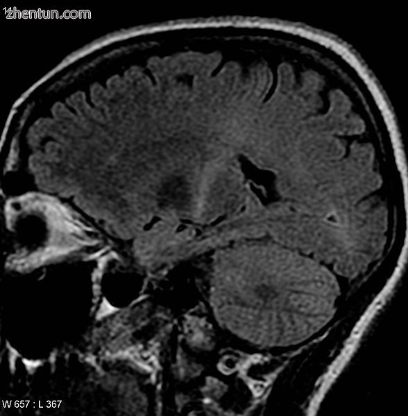 An MRI with increased signal in the posterior part of the internal capsule which.jpg