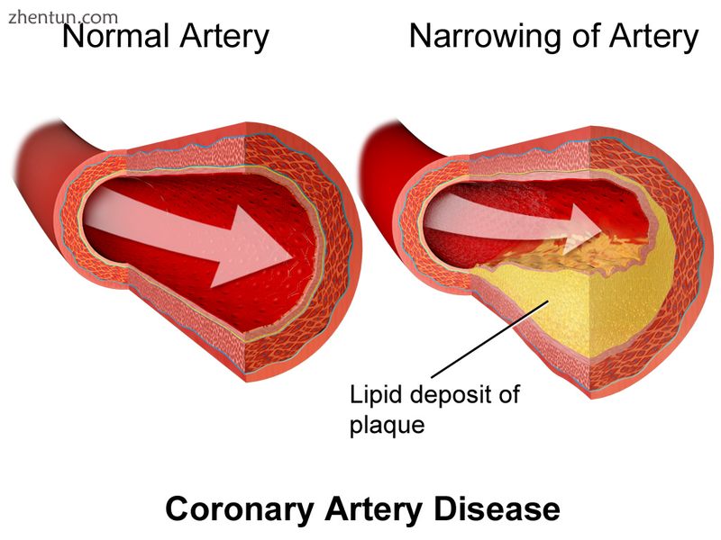 Illustration depicting coronary artery disease.png