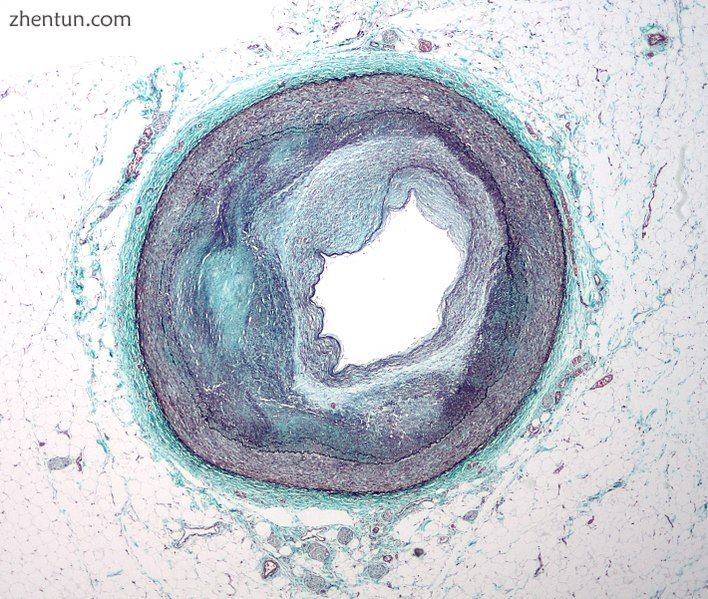 Micrograph of a coronary artery with the most common form of coronary artery dis.jpg