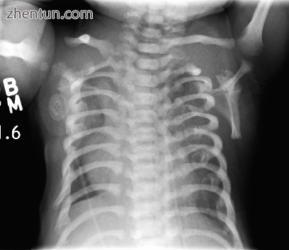 CXR of a newborn with asphyxiating thoracic dysplasia. Note the short ribs..png